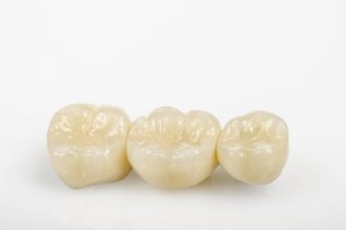weißere Zähne durch professionelle Zahnreinigung