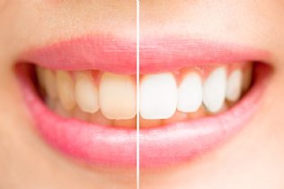 Teilprothese Zahn