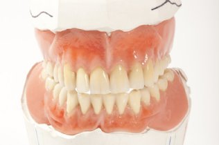 abgebrochener Zahn