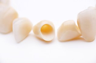 Zahn Implantation